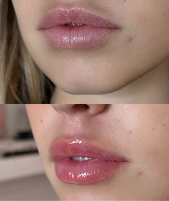 Revanesse Lip Plumper