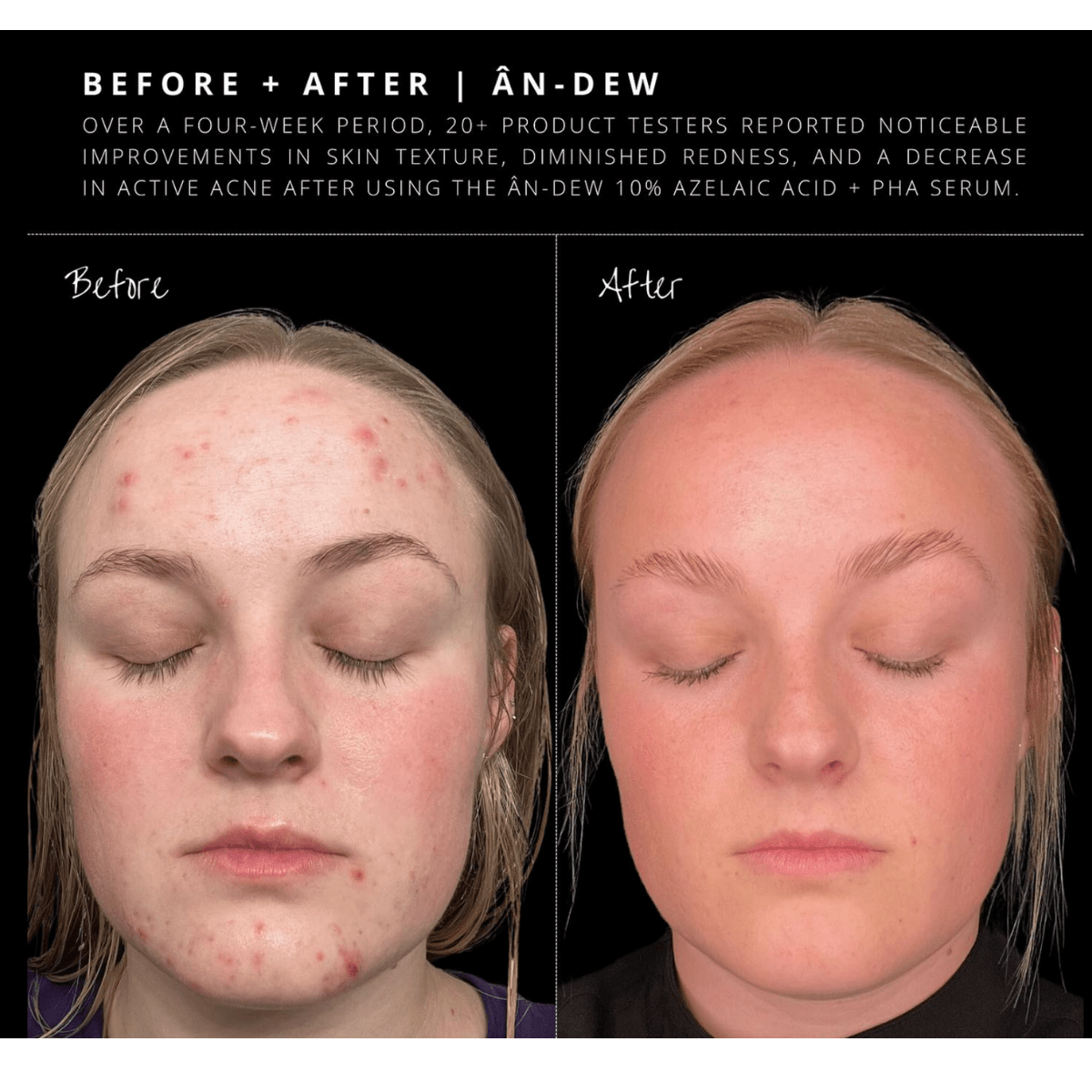 Anfisa ÂN - DEW 10% Azelaic Acid + PHA Serum - The Look and Co