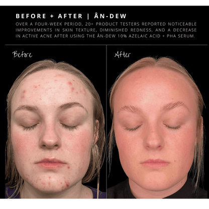 Anfisa ÂN - DEW 10% Azelaic Acid + PHA Serum - The Look and Co