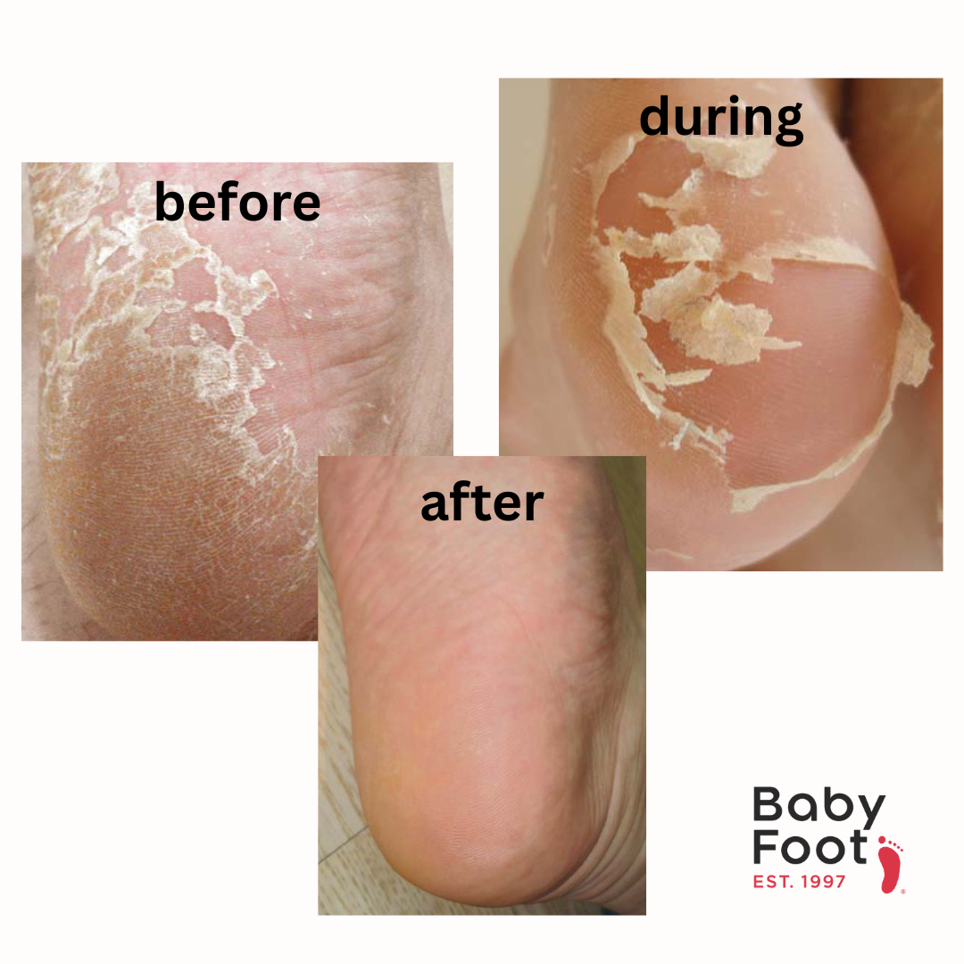 Baby Foot - The Stocking Stuffer Edition - Original Exfoliation Foot Peel