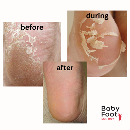 Baby Foot - The Stocking Stuffer Edition - Original Exfoliation Foot Peel
